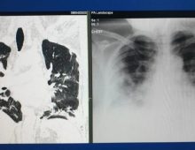 Cum arată plămânii unor tineri fără alte afecțiuni după ce s-au infectat cu coronavirus